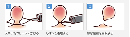 ポリペクトミー