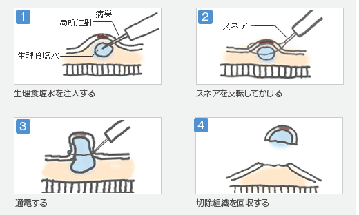 内視鏡的粘膜切除術（EMR）